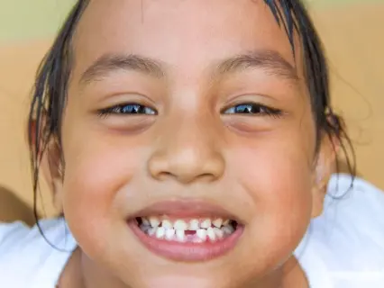 Chipped, Cracked, or Broken Teeth row 1 - Kid Grins Chipped, Cracked, or Broken Teeth row 1 - Kid Grins