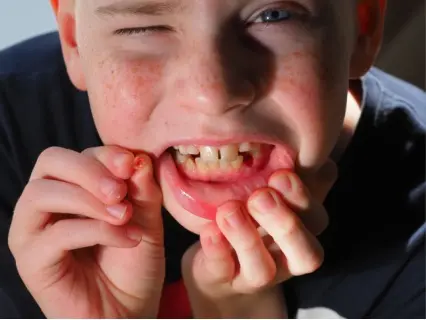 webp/Knocked-Out-Tooth-Row-1-Kid-Grins-Is-Who-You-Want-to-Help.webpnuypa3.webp Knocked Out Tooth Row 1 - Kid Grins Is Who You Want to Help