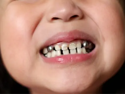 Why Baby Teeth Sometimes Need Dental Crowns - Kid Grins Can Help you Decide If Your Child Needs Them Why Baby Teeth Sometimes Need Dental Crowns - Kid Grins Can Help you Decide If Your Child Needs Them